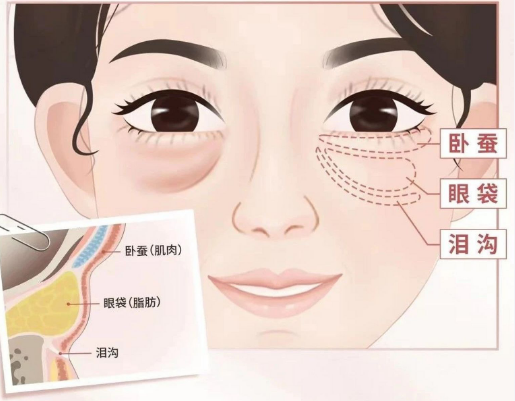 去眼袋手术