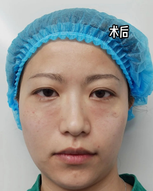 去眼袋手术