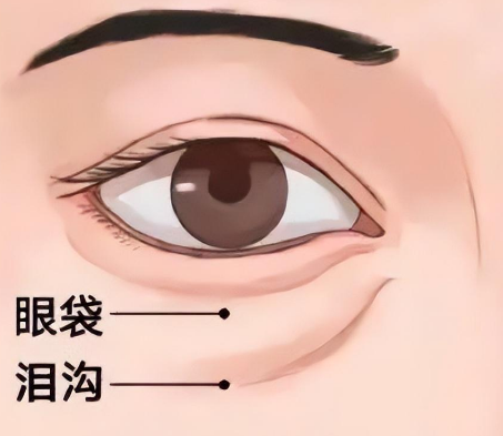 去眼袋手术