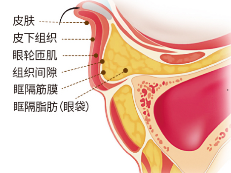 去眼袋手术
