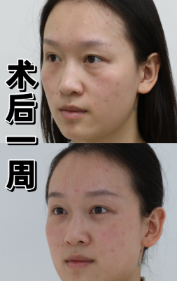 眼袋