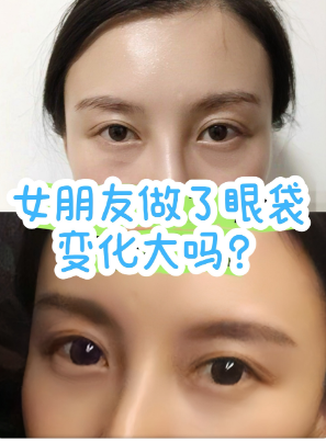 眼袋