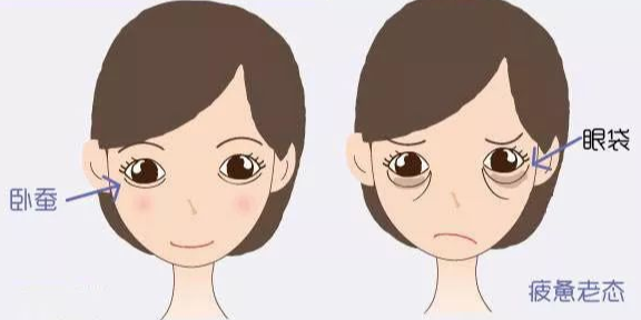 去眼袋手术