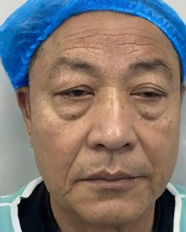 去眼袋手术