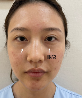 去眼袋手术