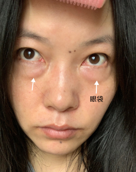 去眼袋手术