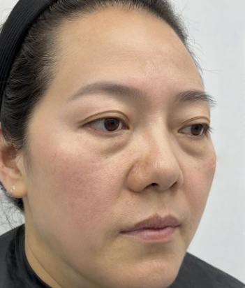 去眼袋手术