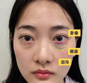 眼袋