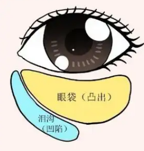 眼袋