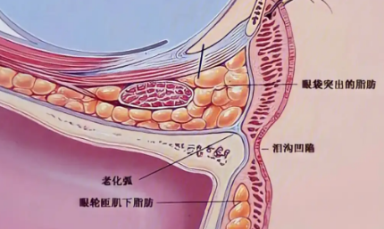 眼袋