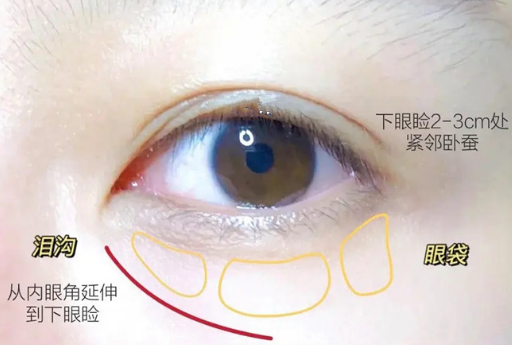 眼袋