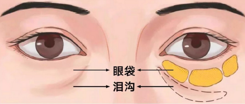 眼袋