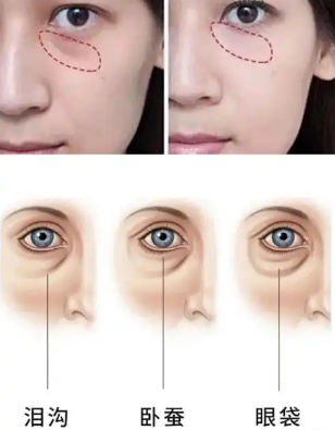 眼袋