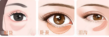 眼袋