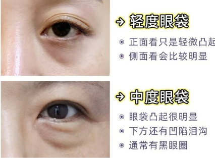 眼袋