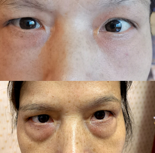 眼袋