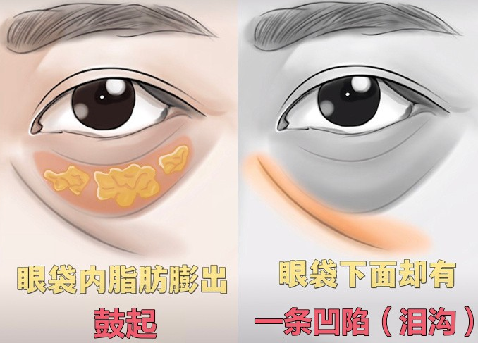 眼袋