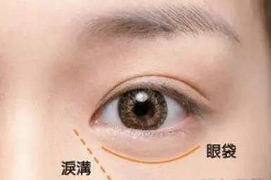 眼袋