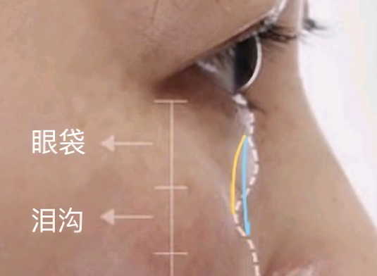 眼袋