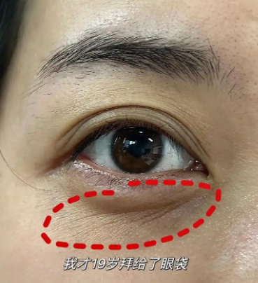 眼袋