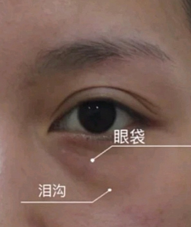 眼袋