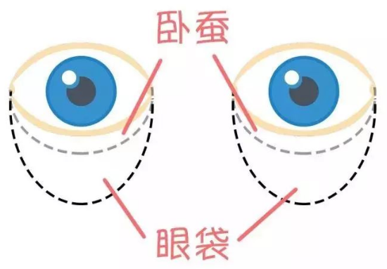 去眼袋手术