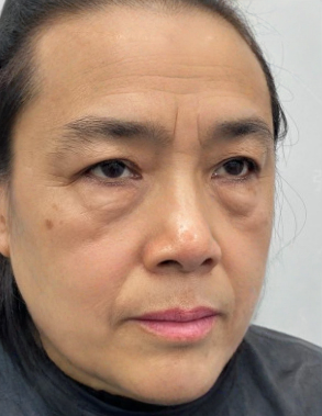 去眼袋手术