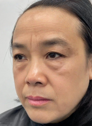 去眼袋手术