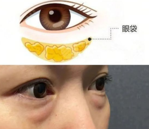 去眼袋手术