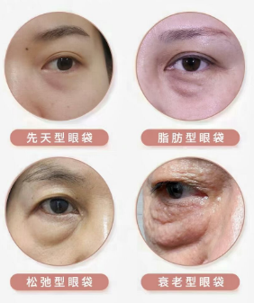 去眼袋手术