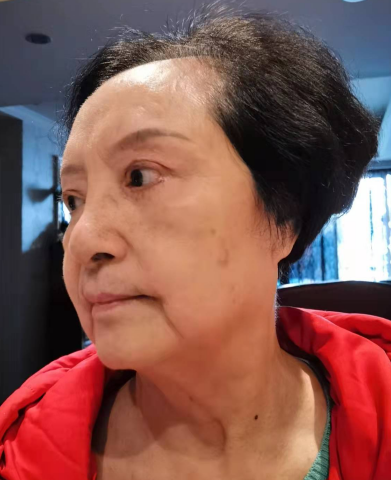 去眼袋手术