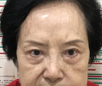 去眼袋手术