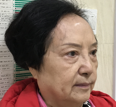 去眼袋手术