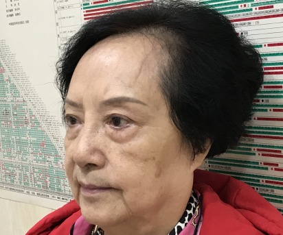 去眼袋手术