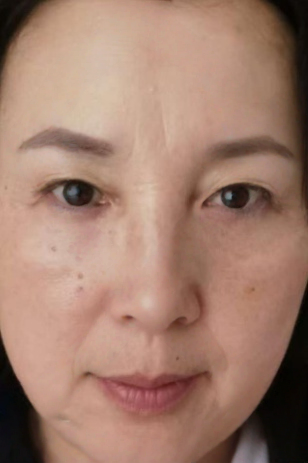 去眼袋手术