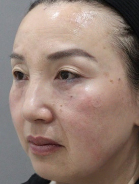 去眼袋手术