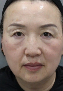 去眼袋手术