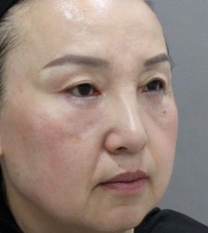 去眼袋手术
