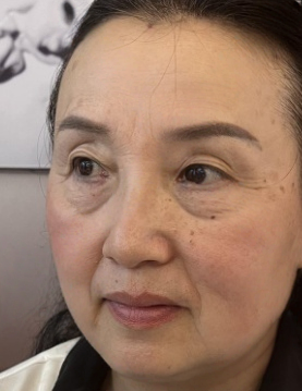 去眼袋手术