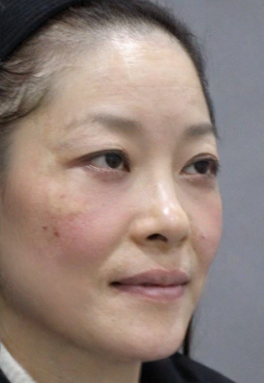 去眼袋手术