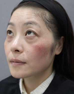 去眼袋手术