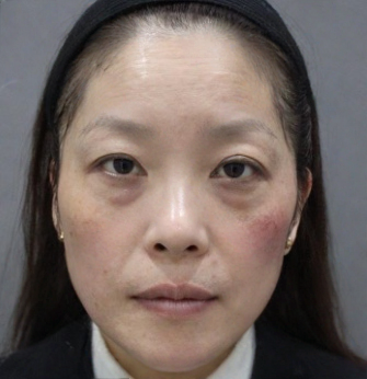 去眼袋手术