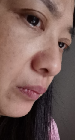 去眼袋手术