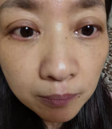 去眼袋手术