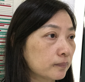 去眼袋手术
