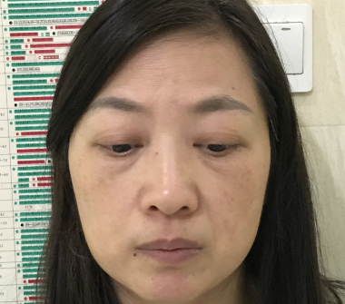 去眼袋手术