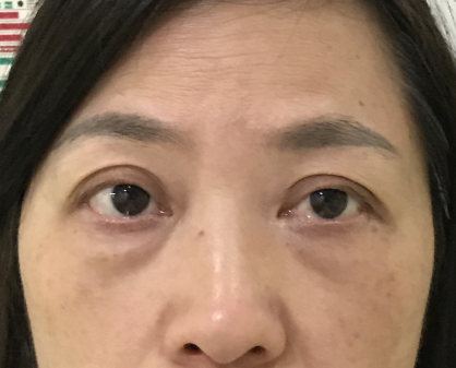 去眼袋手术
