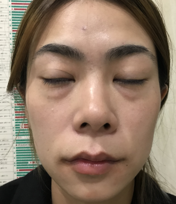 去眼袋手术