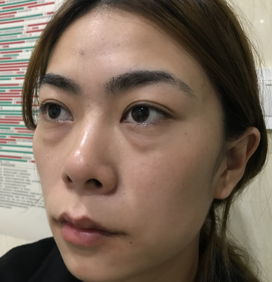 去眼袋手术