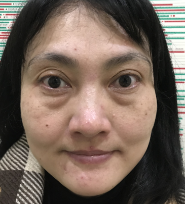 去眼袋手术